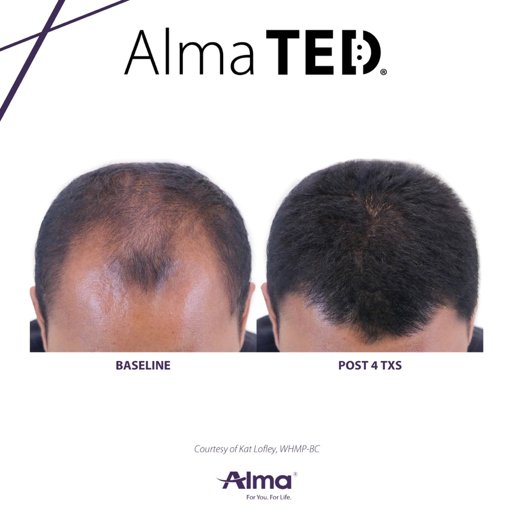 Alma TED hair restoration before and after — baseline vs post 4 treatments (Alma clinical photo)