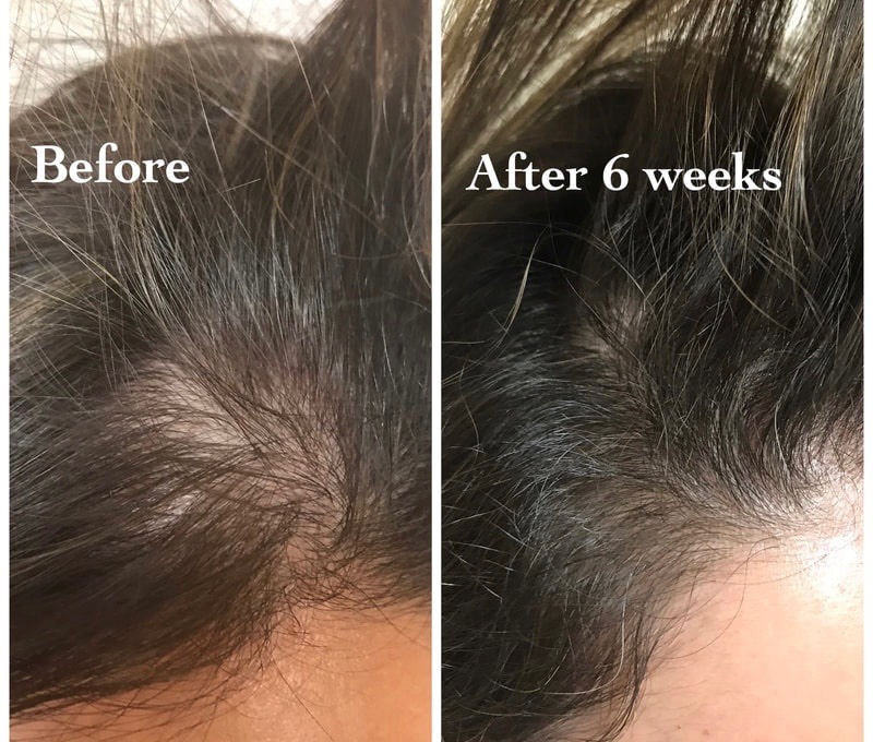 Hair restoration before and after at HQ Med Spa in Flushing - thinning at the part filled in after 6 weeks