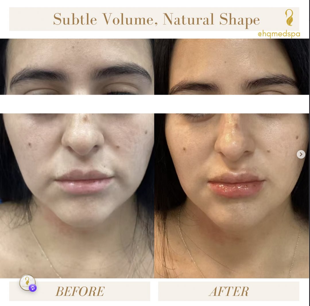 Before and after subtle lip filler (Obagi SAYPHA hyaluronic acid) at HQ Med Spa, Flushing Queens NY