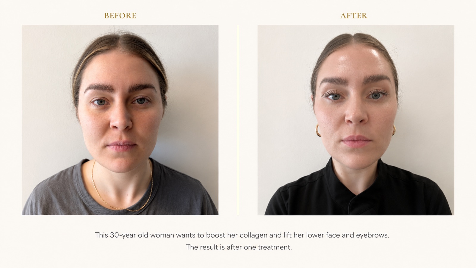 Ultherapy before and after results at HQ Med Spa Flushing Queens NY